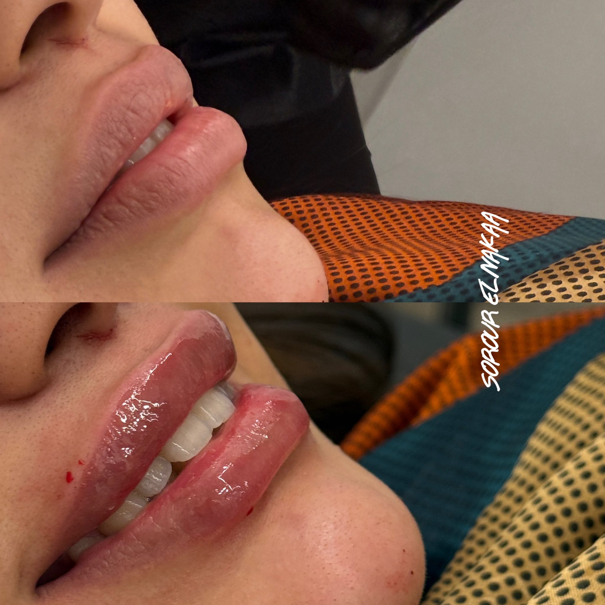 فيلر الشفايف